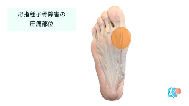 母趾種子骨障害　圧痛